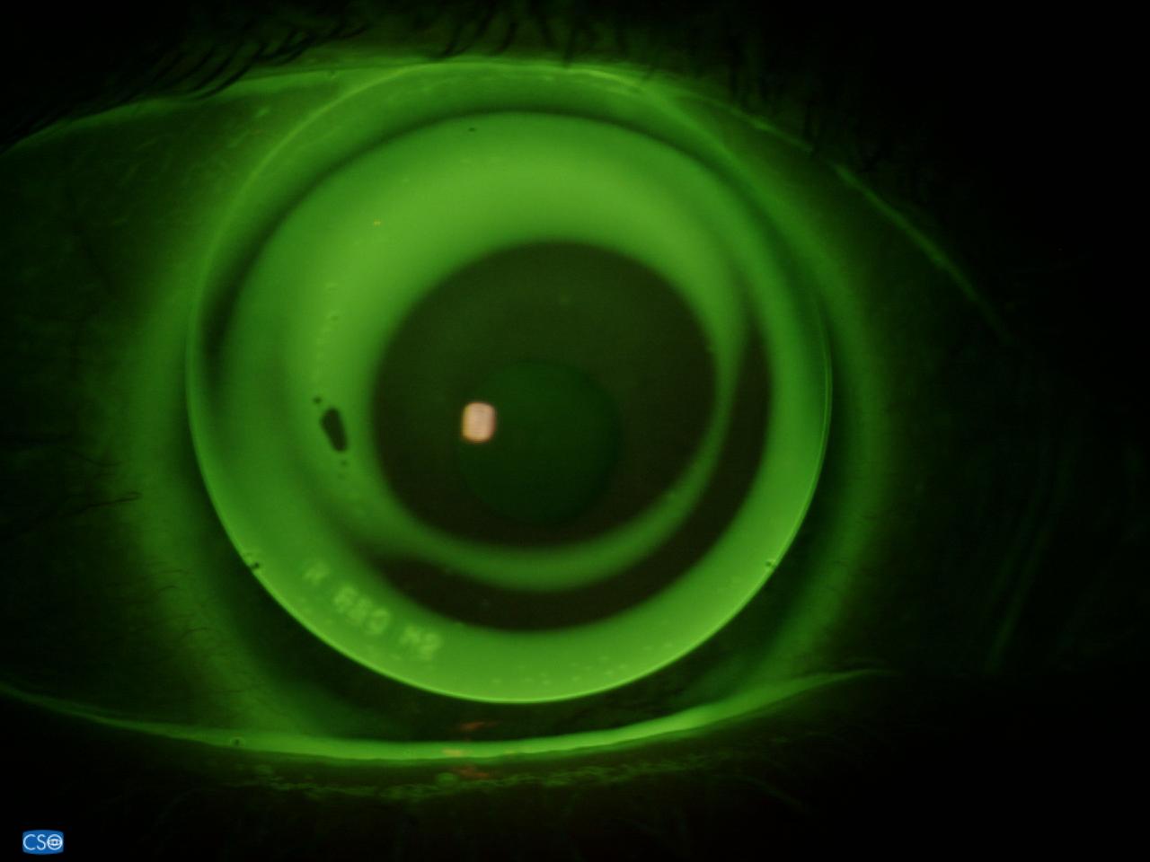 RGP keratoconuslens op vinger