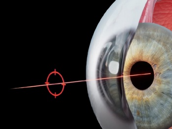 Proefpassing contactlens