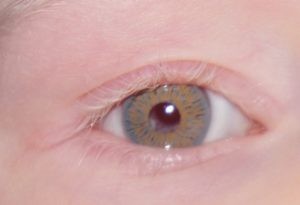 Albino oog met irisprintlens resultaat