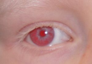 Albino oog zonder lens pigmentverlies