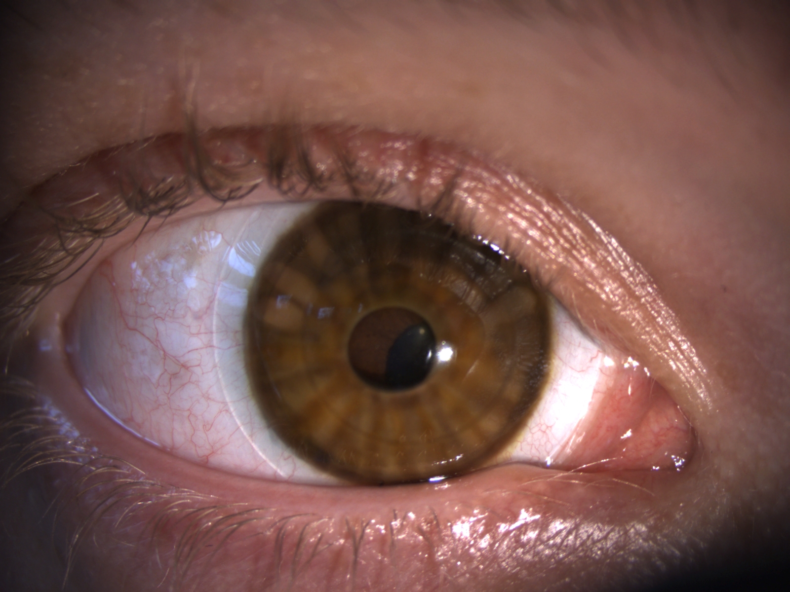 Oog ná medische kleurlens