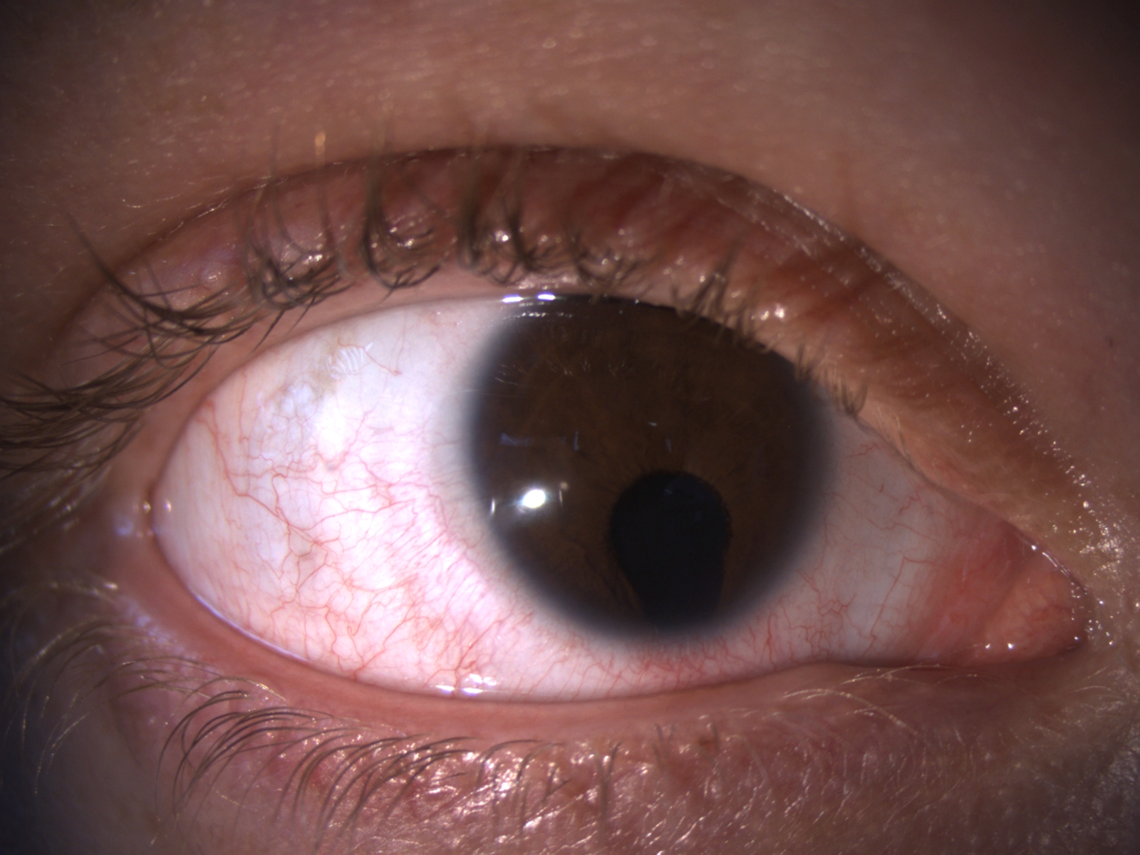 Oog vóór medische kleurlens