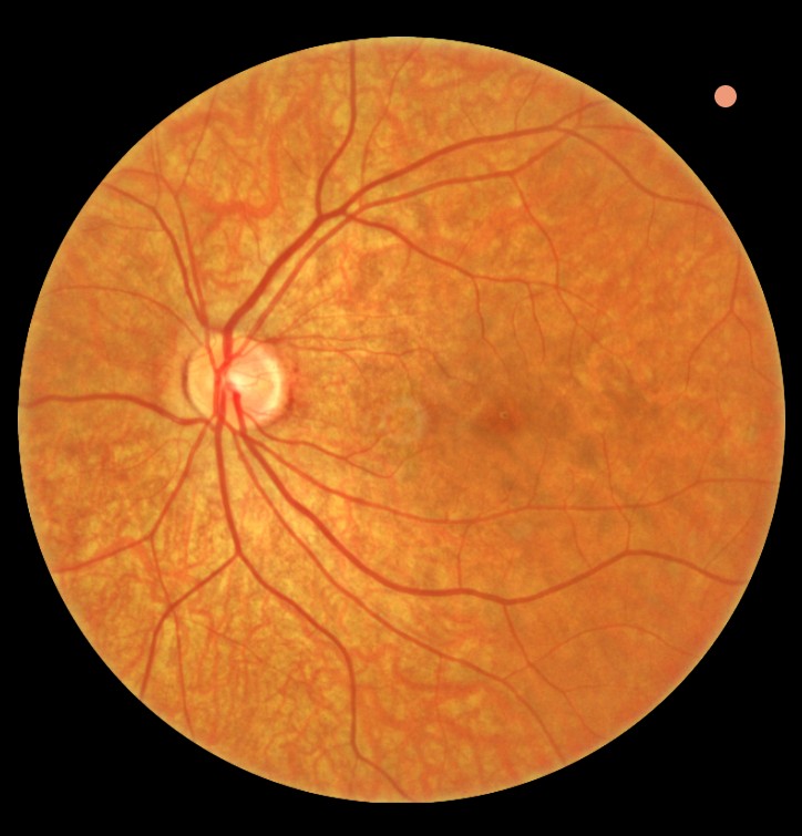 Diabetesscreening onderzoek