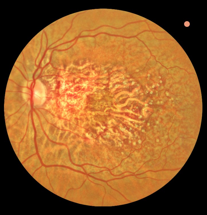 Fundusfotografie netvlies