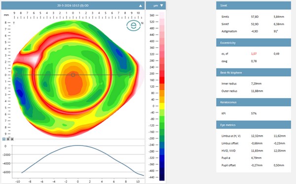 Scleralens aanpassing bij JGK