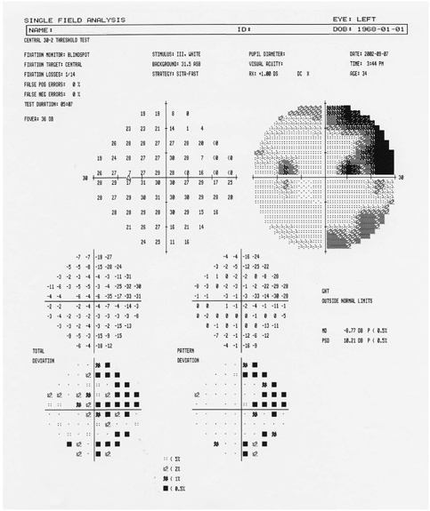 Gezichtsveldonderzoek rijbewijs