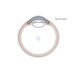 Nippel keratoconus