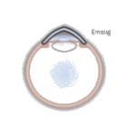 Pellucid marginal degeneration