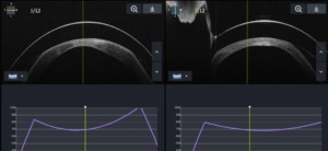 Schematische weergave keratoconus hoornvlies