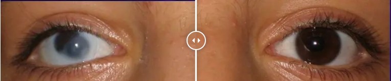 Medische kleurlens beschadigd oog