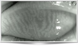 Diagnostiek meibomitis