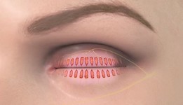 Klachten demodex overgroei