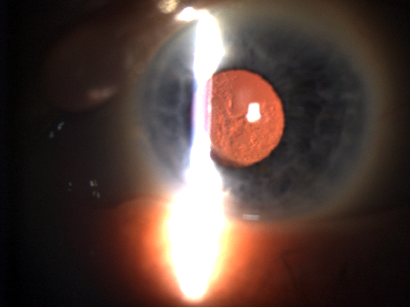 Zo ontstaat cataract