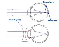 Myopie bijziendheid oogbol groei