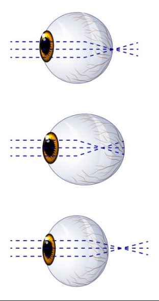 Uitvoeringen zachte lenzen