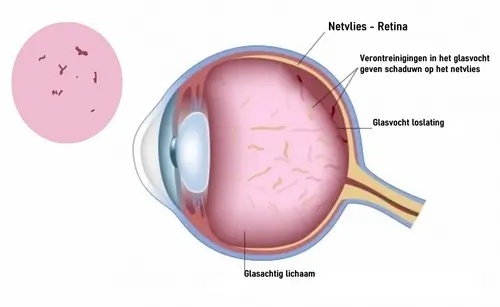 Zwarte vliegjes floaters