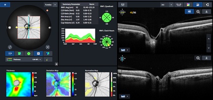 OCT glaucoom overzicht