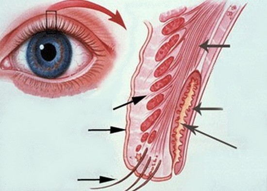 Behandeling meibomitis