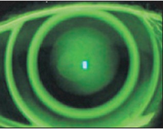 Ortho-K nachtlens onderhoud