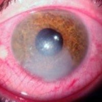 Waarschuwing oogklachten