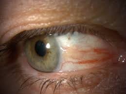 Zwemmen in zee met contactlenzen