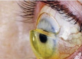 Ptosis scleralens