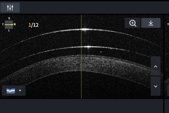 Spleetlamp beoordeling scleralens