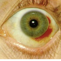 Subconjunctivale bloeding