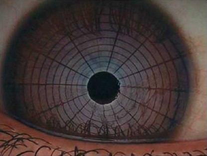 Zachte bandagelens hoornvliesbescherming Sicca