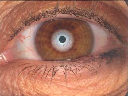 Demodex onderzoek bij JGK