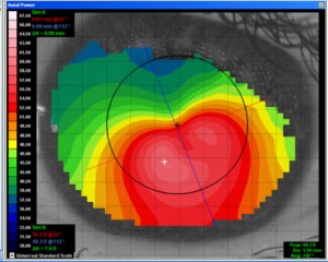 Piggy-back systeem keratoconus