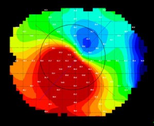 Crosslinking behandeling keratoconus